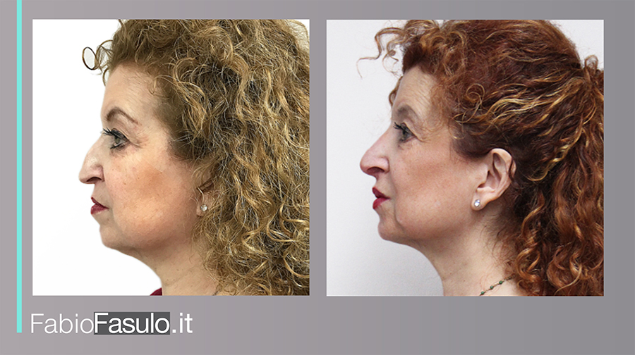 rinofiller prima e dopo